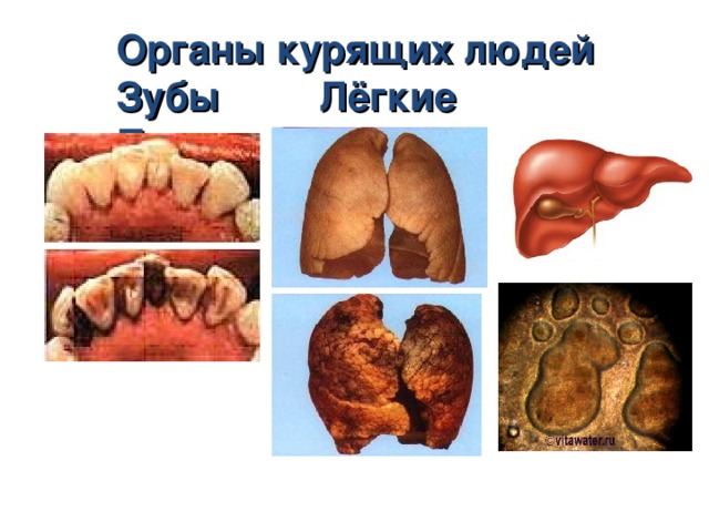 Органы курящих людей Зубы Лёгкие Печень