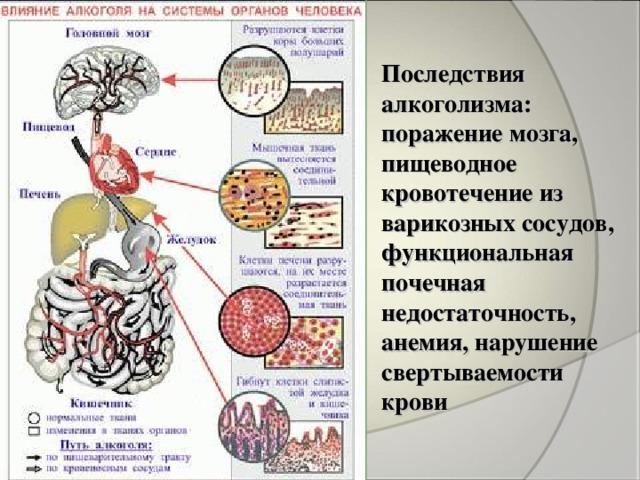 Последствия алкоголизма:  поражение мозга, пищеводное кровотечение из варикозных сосудов, функциональная почечная недостаточность, анемия, нарушение свертываемости крови