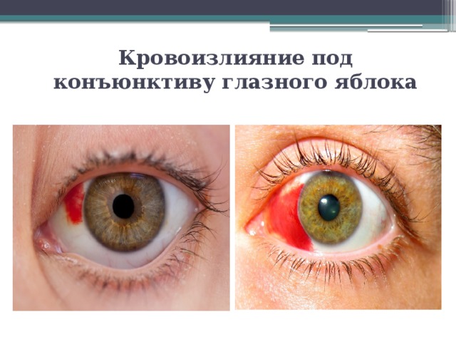 Кровоизлияние под конъюнктиву глазного яблока