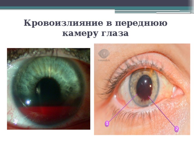 Кровоизлияние в переднюю камеру глаза