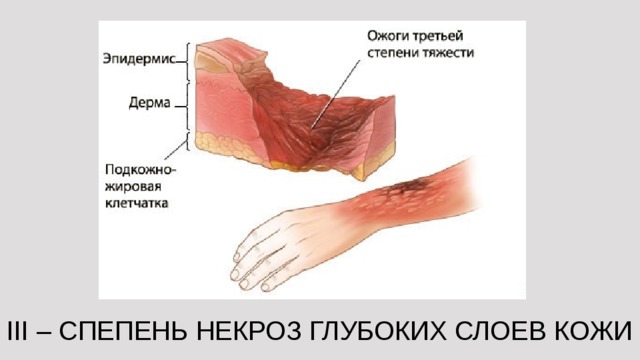 III – СПЕПЕНЬ НЕКРОЗ ГЛУБОКИХ СЛОЕВ КОЖИ