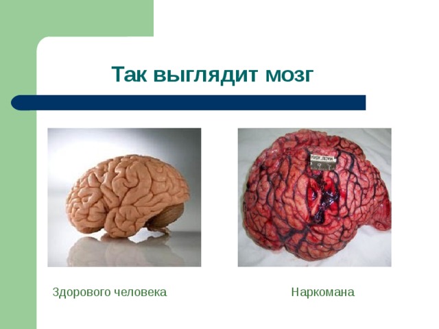 Так выглядит мозг Здорового человека Наркомана