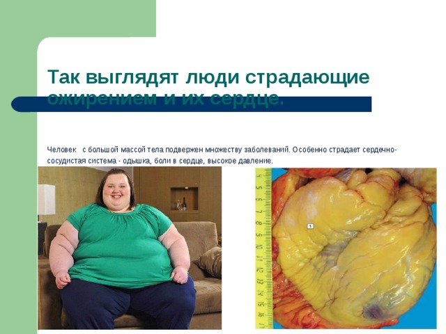 Проблемы здоровья в связи с избыточной массой тела и ожирением презентация