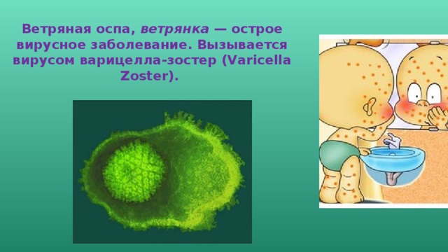 Ветряная оспа, ветрянка — острое вирусное заболевание. Вызывается вирусом варицелла-зостер (Varicella Zoster).