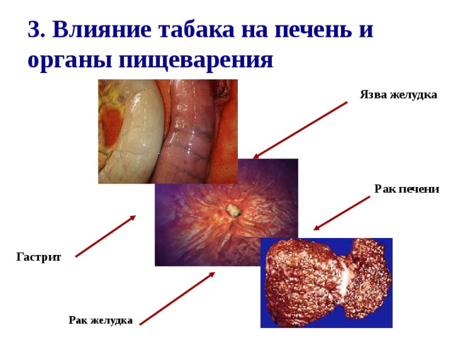 3. Влияние табака на печень и органы пищеварения Язва желудка Рак печени Гастрит Рак желудка