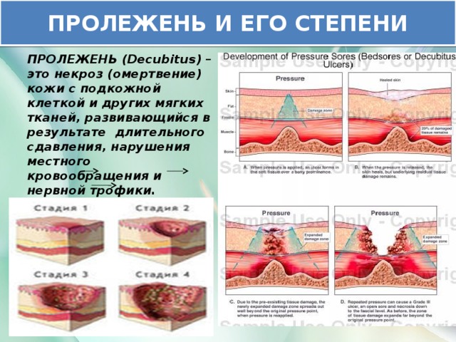 ПРОЛЕЖЕНЬ И ЕГО СТЕПЕНИ ПРОЛЕЖЕНЬ (Decubitus) – это некроз (омертвение) кожи с подкожной клеткой и других мягких тканей, развивающийся в результате длительного сдавления, нарушения местного кровообращения и нервной трофики. Виды пролежней: Степень I Степень II Степень III Степень IV