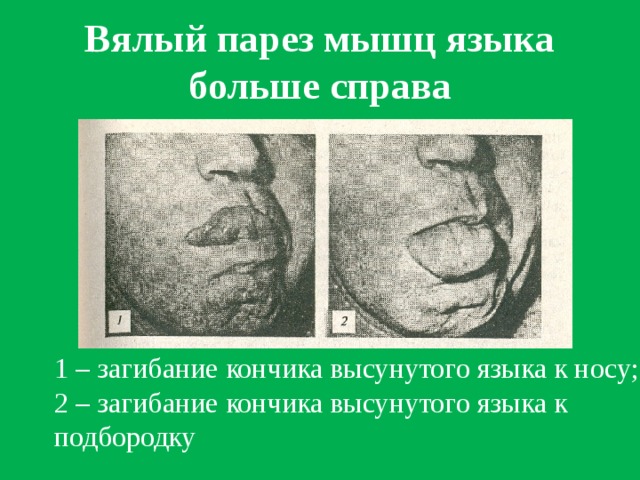 Вялый парез мышц языка больше справа 1 – загибание кончика высунутого языка к носу; 2 – загибание кончика высунутого языка к подбородку
