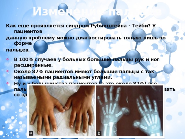 Изменение пальцев Как еще проявляется синдром Рубинштейна - Тейби? У пациентов данную проблему можно диагностировать только лишь по форме пальцев.