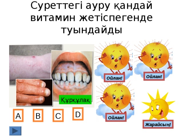 Суреттегі ауру қандай витамин жетіспегенде туындайды Ойлан! Ойлан! Құрқұлақ D А В С Ойлан! Жарайсың!