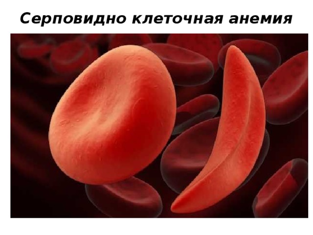 Серповидно клеточная анемия
