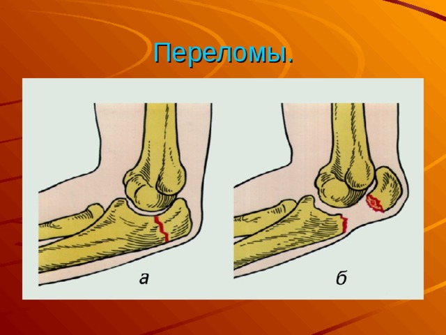 Переломы.