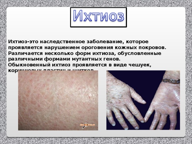 Ихтиоз-это наследственное заболевание, которое проявляется нарушением ороговения кожных покровов. Различается несколько форм ихтиоза, обусловленные различными формами мутантных генов. Обыкновенный ихтиоз проявляется в виде чешуек, коричневых пластин и щитков.