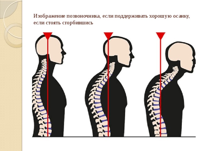 Изображение позвоночника, если поддерживать хорошую осанку, если стоять сгорбившись