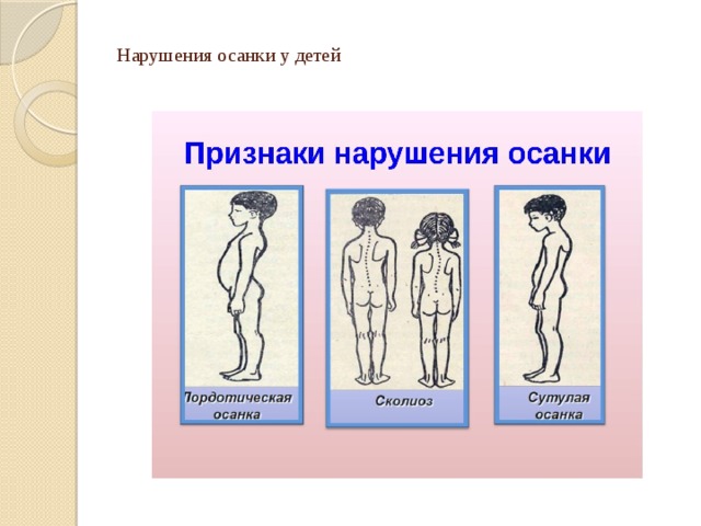 Нарушения осанки у детей