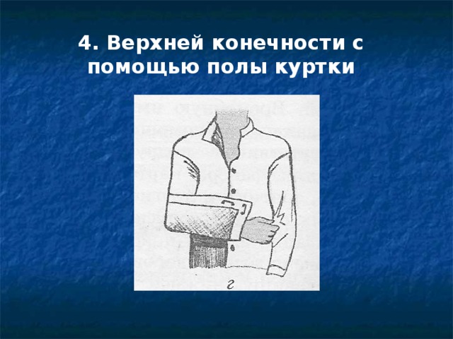 4. Верхней конечности с помощью полы куртки
