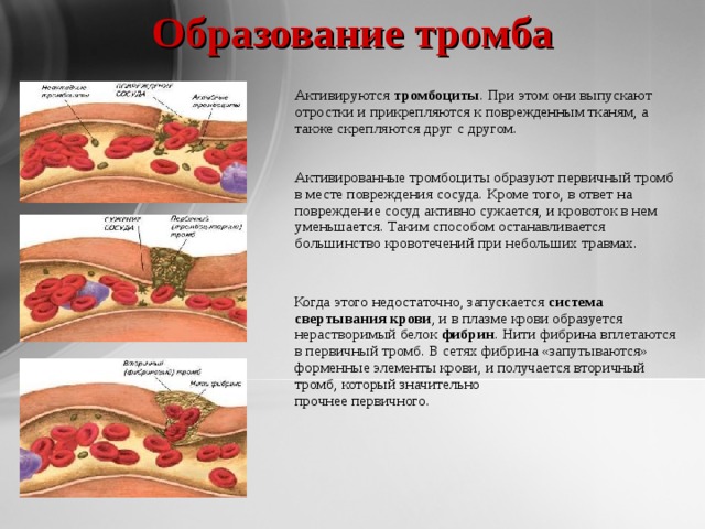 Образование тромба   Активируются  тромбоциты . При этом они выпускают отростки и прикрепляются к поврежденным тканям, а также скрепляются друг с другом.    Активированные тромбоциты образуют первичный тромб в месте повреждения сосуда. Кроме того, в ответ на повреждение сосуд активно сужается, и кровоток в нем уменьшается. Таким способом останавливается большинство кровотечений при небольших травмах.  Когда этого недостаточно, запускается  система свертывания крови , и в плазме крови образуется нерастворимый белок  фибрин . Нити фибрина вплетаются в первичный тромб. В сетях фибрина «запутываются» форменные элементы крови, и получается вторичный тромб, который значительно  прочнее первичного.