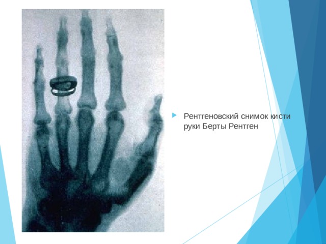 Рентгеновский снимок кисти руки Берты Рентген