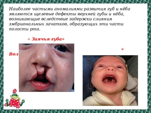Наиболее частыми аномалиями развития губ и нёба являются щелевые дефекты верхней губы и нёба, возникающие вследствие задержки слияния эмбриональных зачатков, образующих эти части полости рта.    « Заячья губа»    « Волчья пасть»