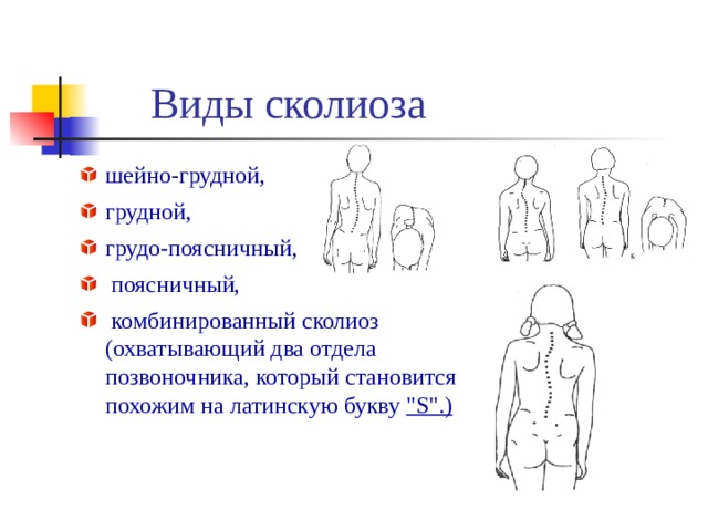 Виды сколиоза шейно-грудной, грудной, грудо-поясничный,  поясничный,  комбинированный сколиоз  (охватывающий два отдела  позвоночника, который становится  похожим на латинскую букву 