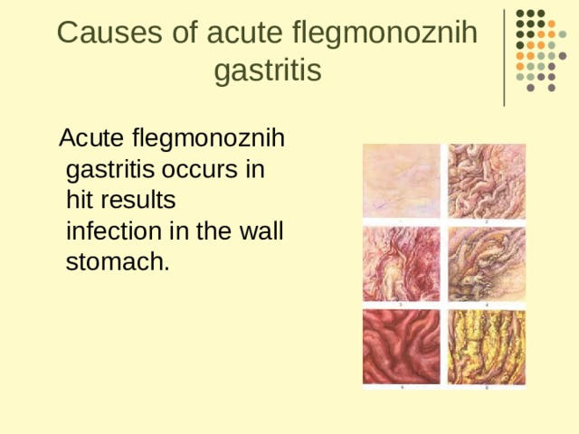 Causes of acute flegmonoznih gastritis  Acute flegmonoznih  gastritis occurs in  hit results  infection in the wall  stomach.