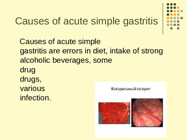 Causes of acute simple gastritis  Causes of acute simple   gastritis are errors in diet, intake of strong   alcoholic beverages, some   drug   drugs,   various  infection.