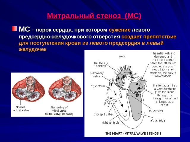 Митральный стеноз (МС)