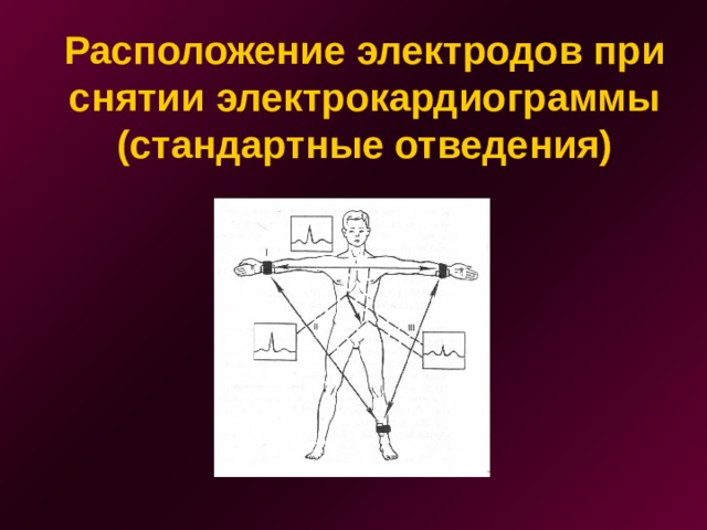 Расположение электродов при снятии электрокардиограммы  (стандартные отведения)