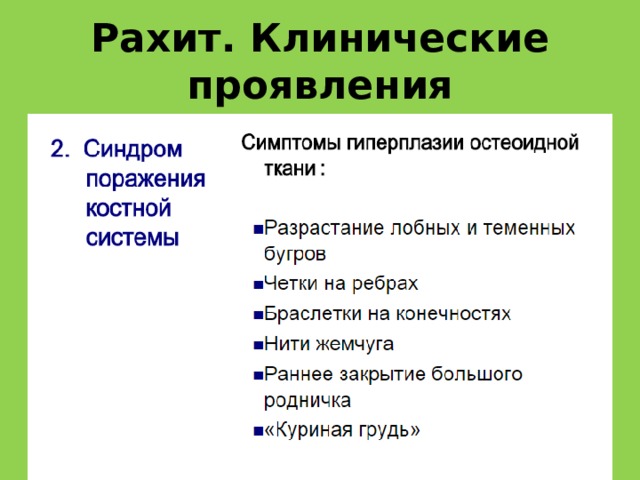 Рахит. Клинические проявления