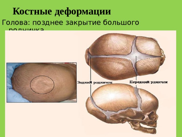 Костные деформации Голова: позднее закрытие большого родничка