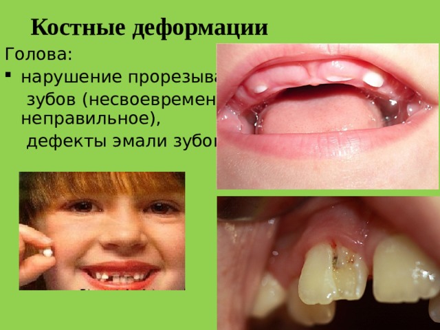Костные деформации Голова: нарушение прорезывания  зубов (несвоевременное, неправильное),  дефекты эмали зубов.