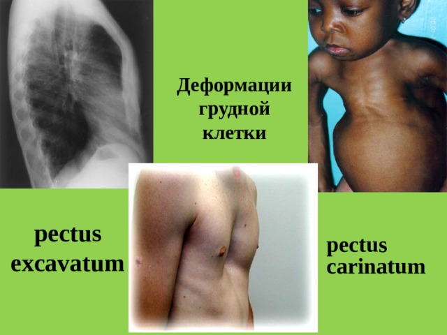 Деформации грудной клетки   pectus excavatum  pectus carinatum