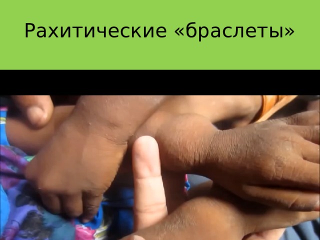 Рахитические «браслеты» The ends of the long bones demonstrate that same knobby thickening. Growth plate widening is responsible for the enlargement at the wrists and ankles.