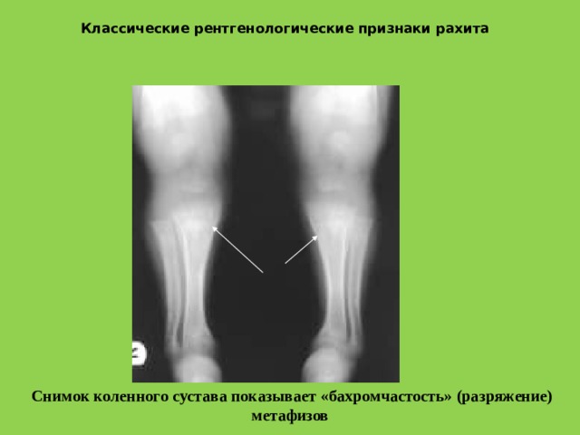 Классические рентгенологические признаки рахита  Снимок коленного сустава показывает «бахромчастость» (разряжение) метафизов