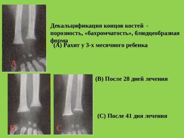 Декальцификация концов костей - порозность, «бахромчатость», блюдцеобразная форма  (A) Рахит у 3-х месячного ребенка A (B) После 28 дней лечения (C) После 41 дня лечения B C