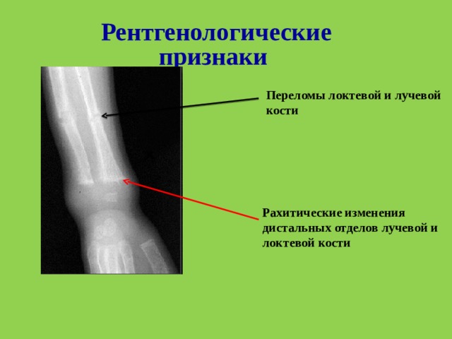 Рентгенологические признаки  Переломы локтевой и лучевой кости Рахитические изменения дистальных отделов лучевой и локтевой кости