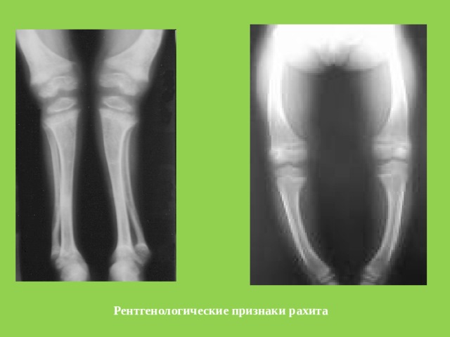 Рентгенологические признаки рахита