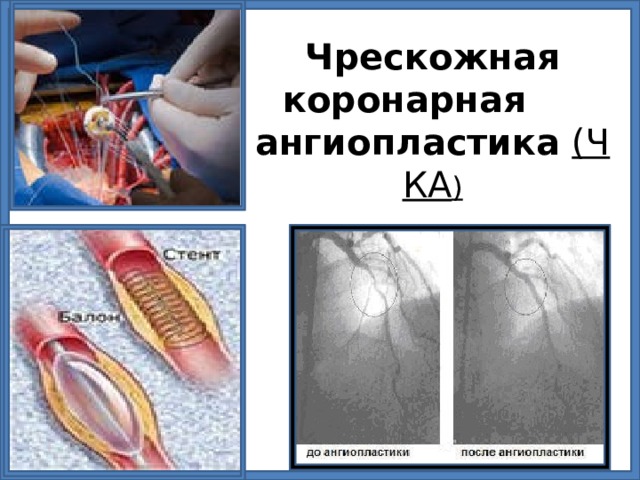 Чрескожная  коронарная  ангиопластика   (ЧКА )