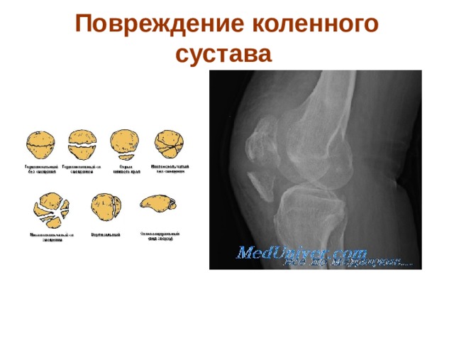 Повреждение коленного сустава
