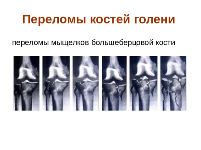 Переломы костей голени  переломы мыщелков большеберцовой кости
