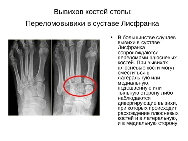 Вывихов костей стопы:  Переломовывихи в суставе Лисфранка