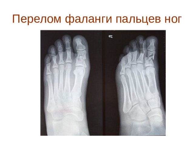 Перелом фаланги пальцев ног