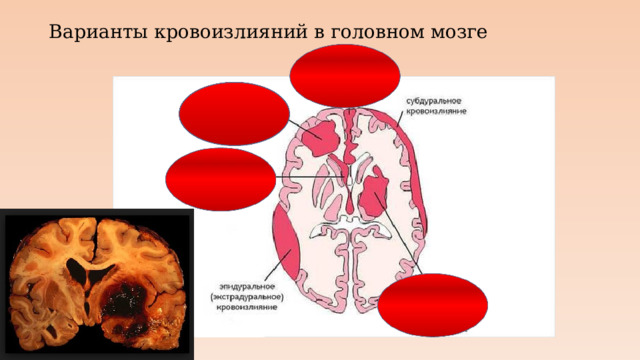 Варианты кровоизлияний в головном мозге