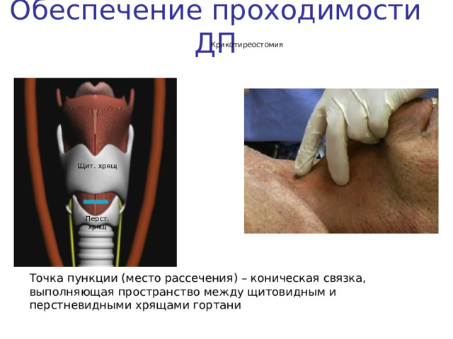 Обеспечение проходимости ДП Крикотиреостомия Щит. хрящ Перст. хрящ Точка пункции (место рассечения) – коническая связка, выполняющая пространство между щитовидным и перстневидными хрящами гортани