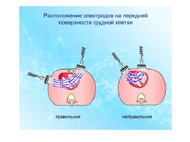 Расположение электродов : трансторакальный ток будет максимальным, если сердце будет располагаться точно между ними.  Существуют три основные позиции расположения электродов:   - стандартное передневерхушечное (под правой ключицей справа от грудины – в точке отведения V 6)   - биаксиллярная позиция – каждый из электродов на боковой поверхности грудной клетки;   - передне-заднее положение (на передней поверхности грудной клетки слева в проекции сердца, второй – под левой лопаткой).  Нестандартные положения можно применять у пациентов с имплантированными внутренними кардиостимуляторами или кардиовертерами для избежания поломки этих устройств.  В многочисленных исследованиях было показано, что при применении нестандартных позиций электродов, не важно с точки зрения конечного эффекта, какой электрод (стернальный или апикальный) в какую из указанных позиций будет помещен