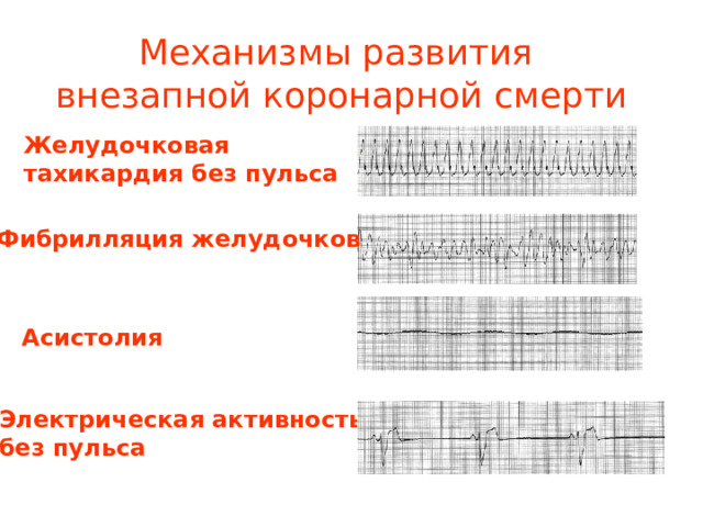 Механизмы развития внезапной коронарной смерти Желудочковая тахикардия без пульса Фибрилляция желудочков  Асистолия Функция мониторирования сердечного ритма у современных дефибрилляторов помогает быстро решить проблему установления механизма остановки кровообращения Это важно для выбора содержания и последовательности РСЛР. Нарушения ритма, приводящие к остановке кровообращения подразделяются на 2 группы: 1 Требующие ДФ (ФЖ, ЖТ без пульса) Электрическая активность без пульса