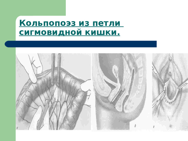 Кольпопоэз из петли  сигмовидной кишки.