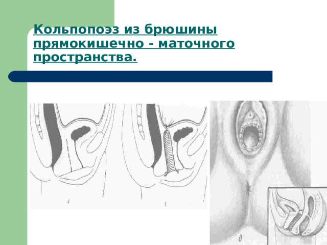 Кольпопоэз из брюшины прямокишечно - маточного пространства.