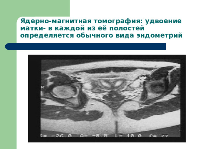 Ядерно-магнитная томография: удвоение матки- в каждой из её полостей определяется обычного вида эндометрий