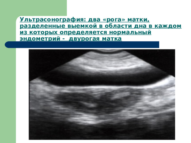 Ультрасонография: два «рога» матки, разделенные выемкой в области дна в каждом из которых определяется нормальный эндометрий - двурогая матка