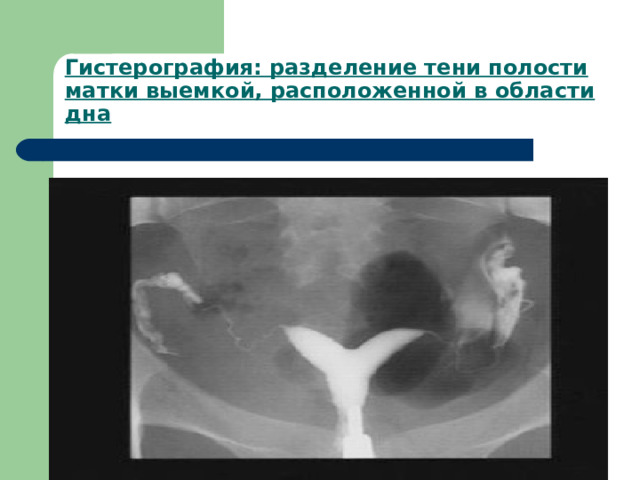 Гистерография: разделение тени полости матки выемкой, расположенной в области дна